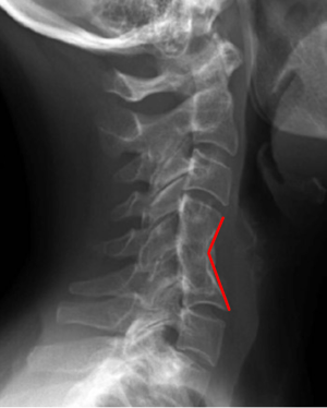 Postoperative Deformity of the Cervical Spine Clinical Gate
